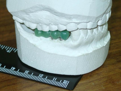 Численный расчет и моделирование ортопедических конструкций с применением зубочелюстных имплантатов